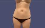 Liposuction 5 - Abdomen and Posterior Flanks Before